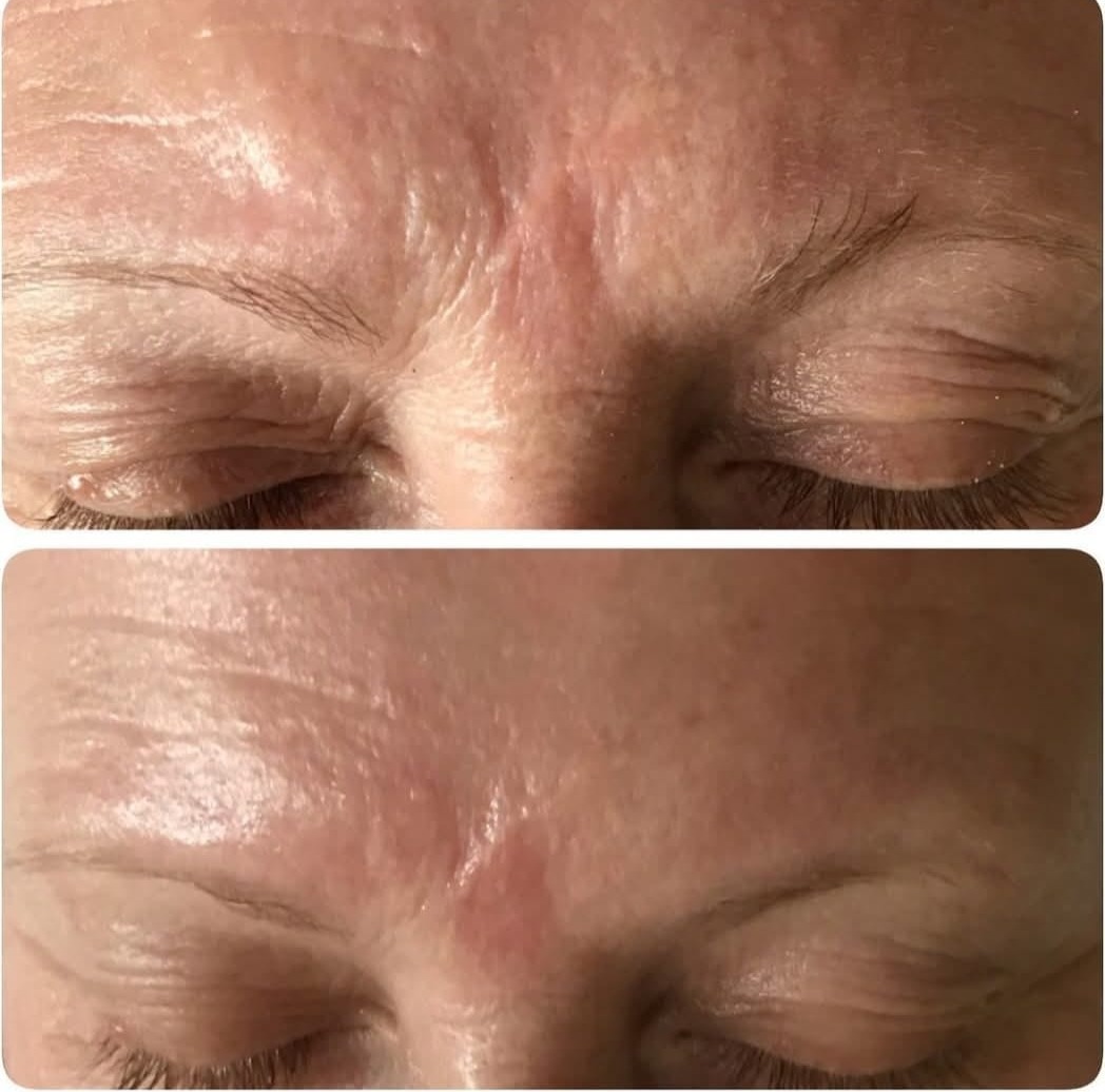 Peeling facial — antes e depois, suavização de linhas e textura da testa